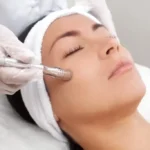 What is Diamond Microdermabrasion Facial