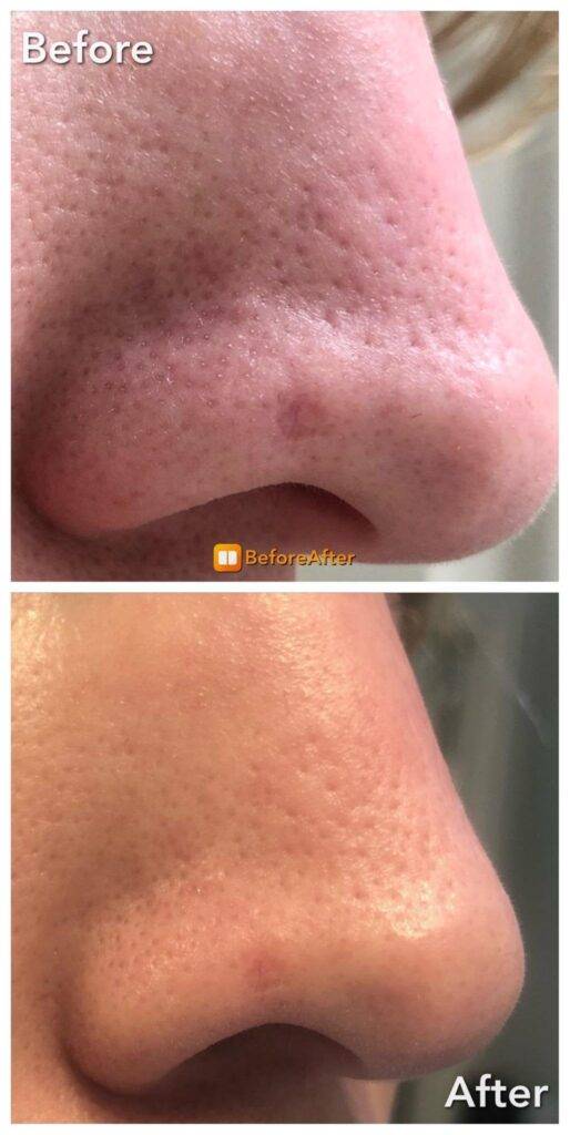 Will Microneedling Reduce Pore Size?