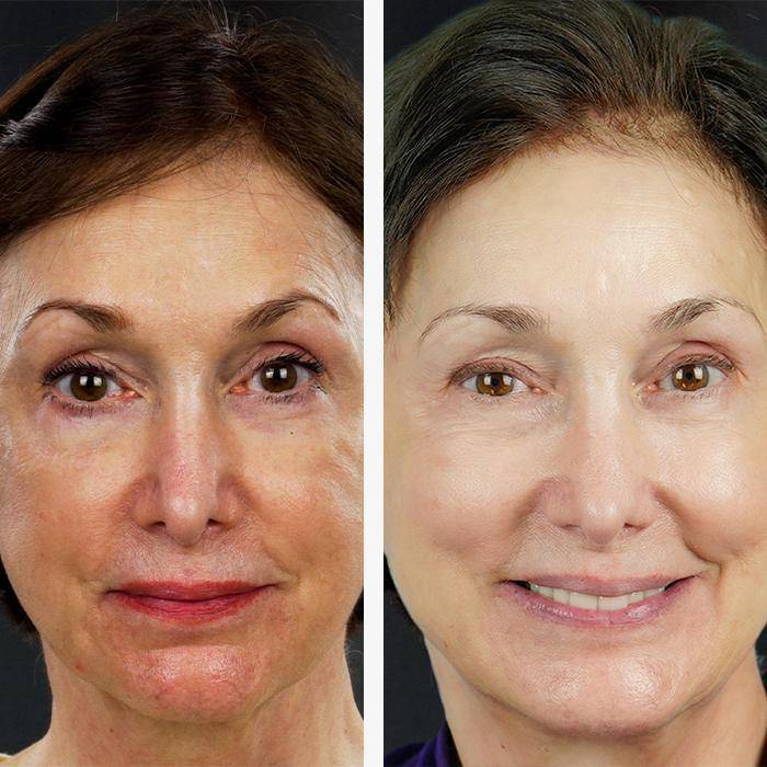 Glycolic Acid Facial
