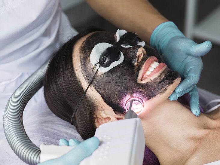 Carbon Peel Laser Benefits