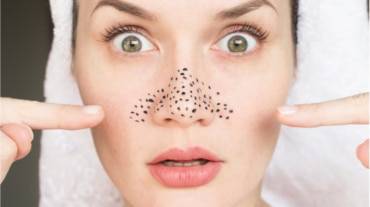 What are Home Remedies to Minimize Large Pores?