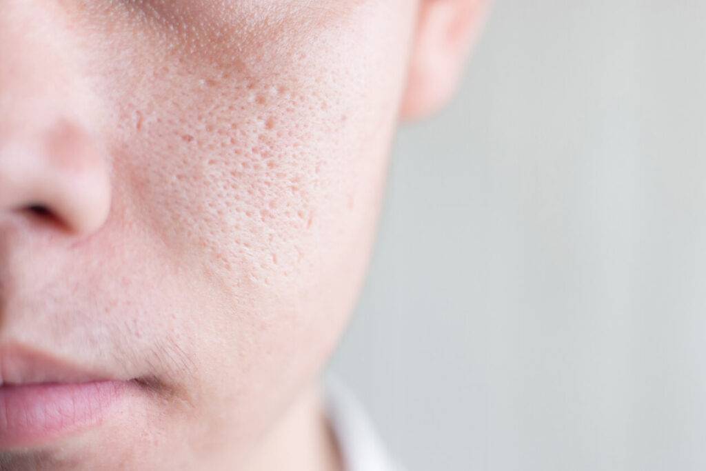 Do Pores Look Bigger When Skin is Oily?