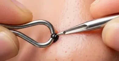 Best Blackhead Extractor Tool for Beginners