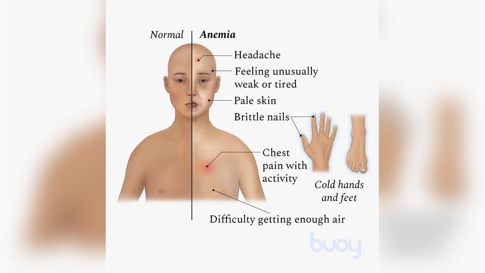 Can Iron Deficiency Cause Pale Skin