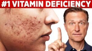 Can Vitamin D Deficiency Cause Acne