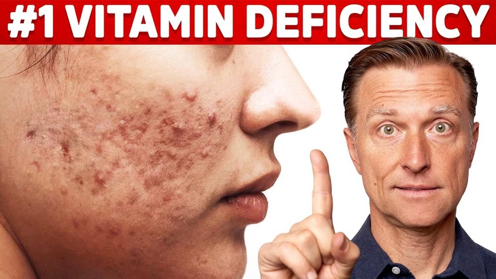Can Vitamin D Deficiency Cause Acne