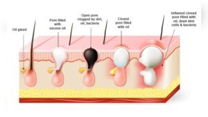 Chin Breakouts Hormonal Causes