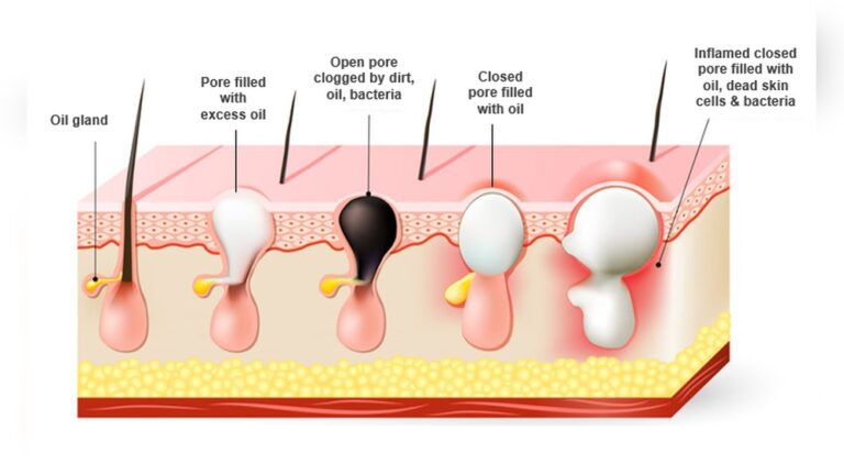 Chin Breakouts Hormonal Causes