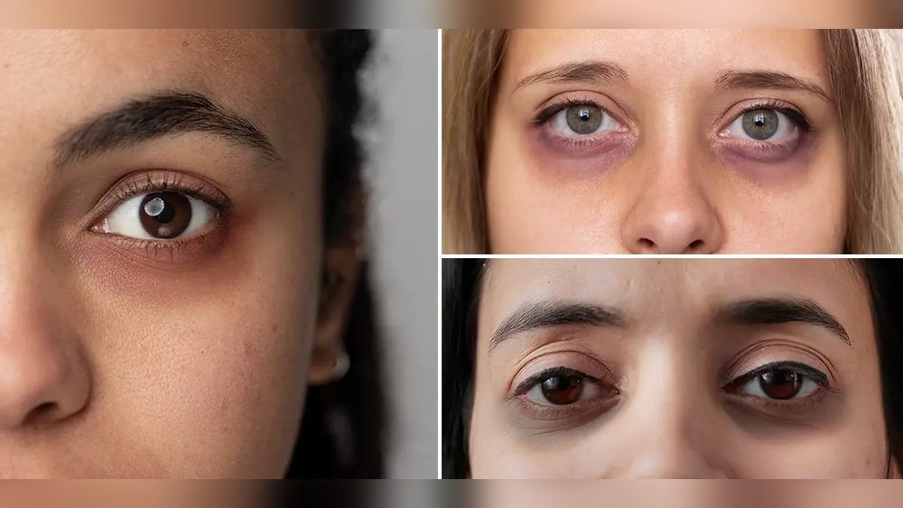 Dark Circles Vs Hyperpigmentation under Eyes