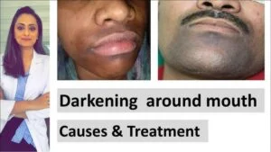 Dark Shadow around Mouth Causes