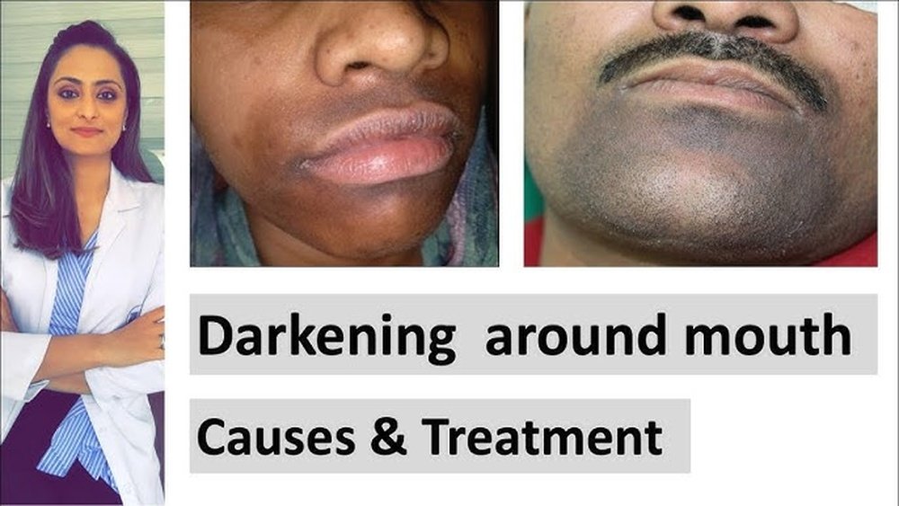 Dark Shadow around Mouth Causes