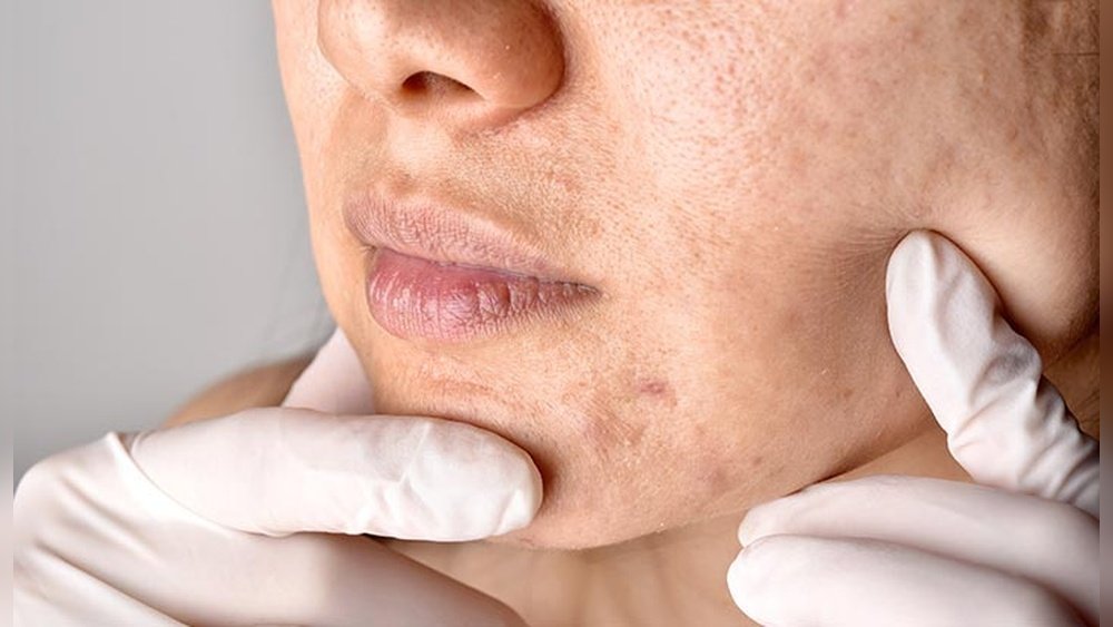 Do Facial Oils Clog Pores