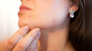 Does Talc Cause Breakouts