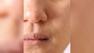 Dry Flaky Nose Skin Treatment