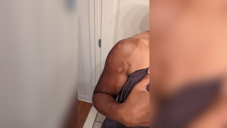 Facial Discoloration After Sunburn