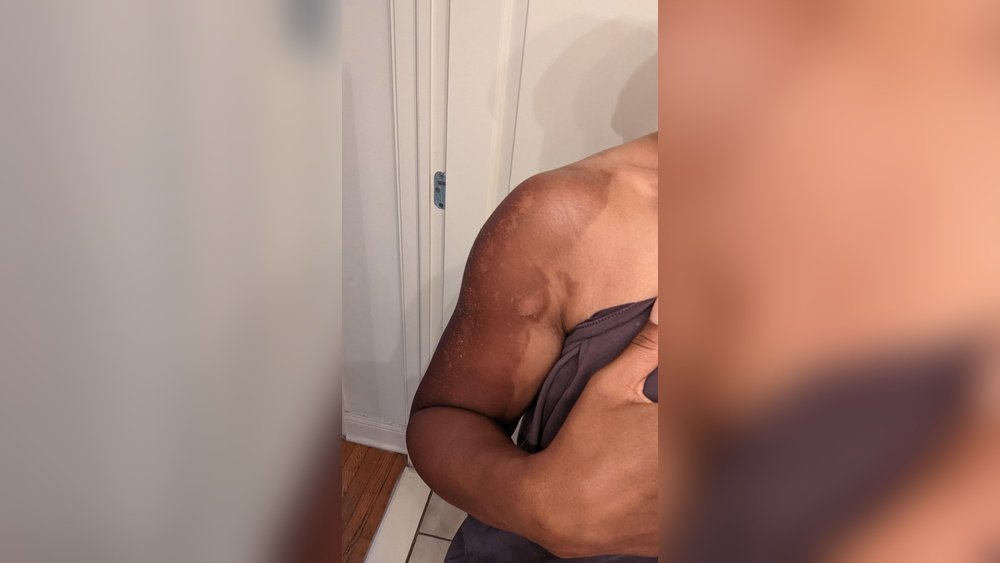 Facial Discoloration After Sunburn