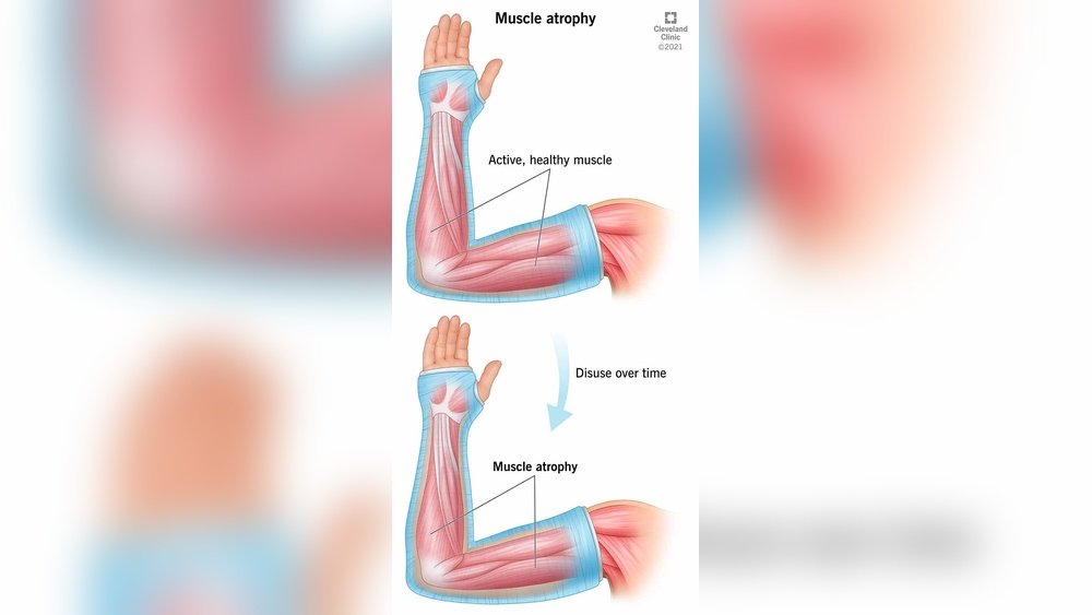 Facial Muscle Atrophy Prevention