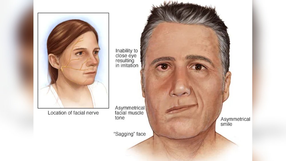 Facial Nerve Sensitivity And Skin Tone