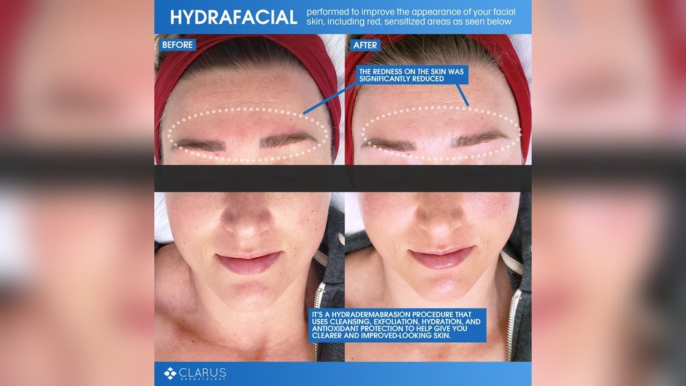 Facial Redness After Exfoliation How to Reduce