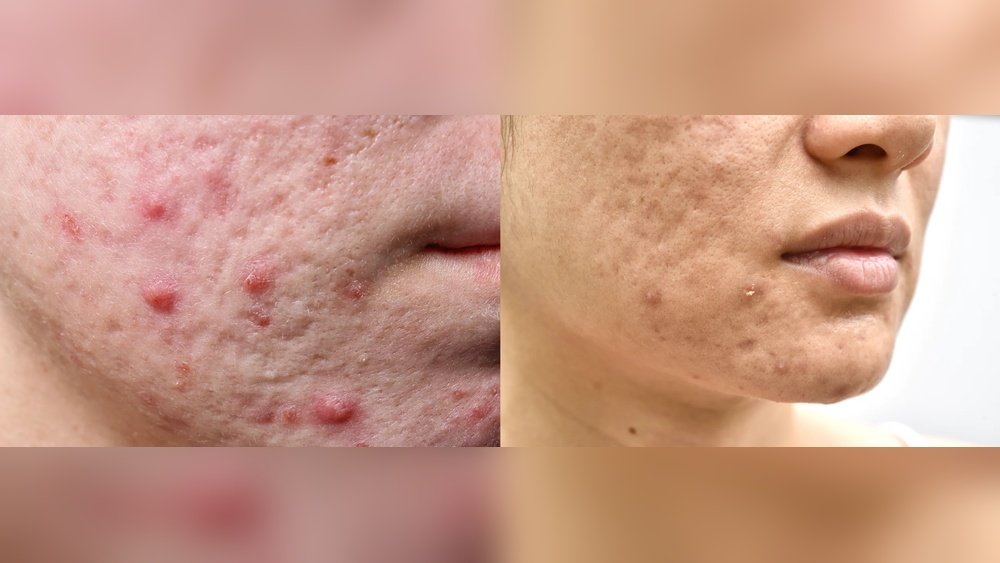 Facial Scars from Acne Cysts Treatment Options