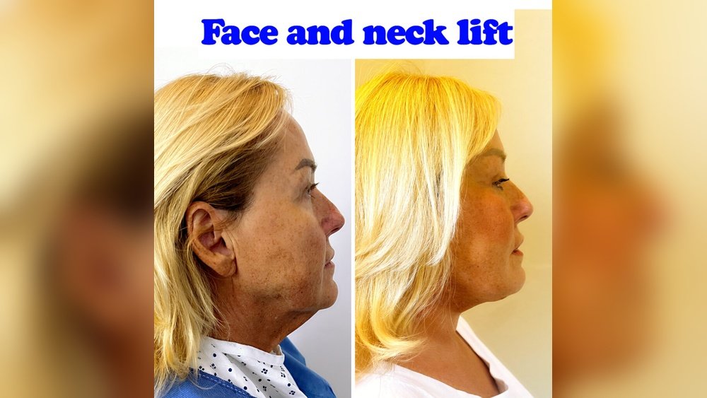Facial Skin Tightening After Weight Loss