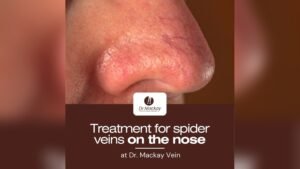 Facial Veins on Nose How to Reduce