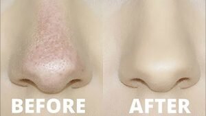 Foundation Sliding off Nose Fix