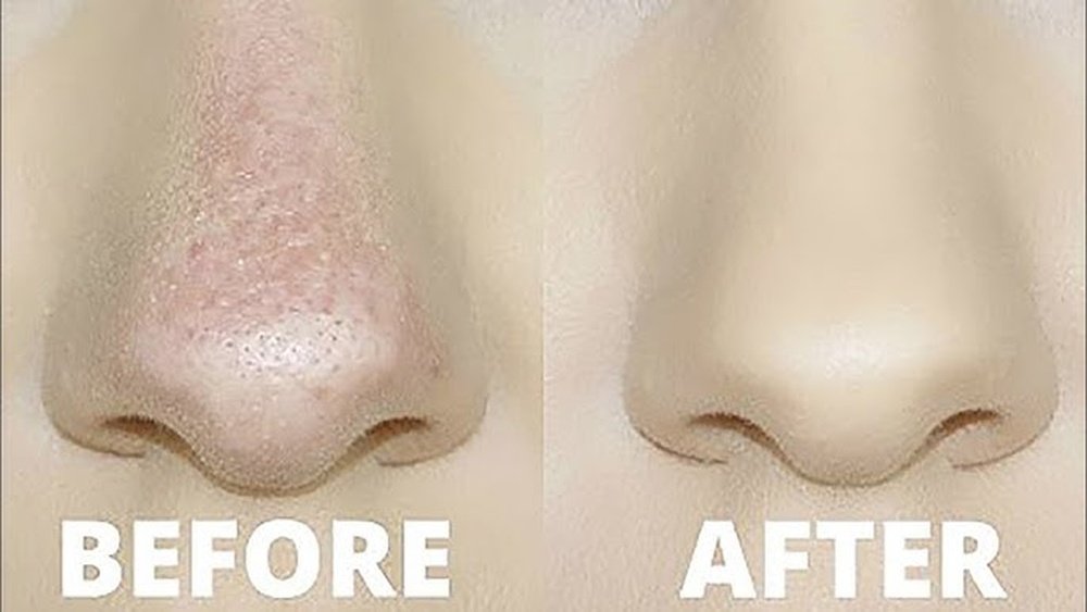 Foundation Sliding off Nose Fix