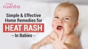 Heat Rash on Face Treatment Naturally