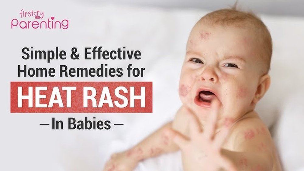 Heat Rash on Face Treatment Naturally