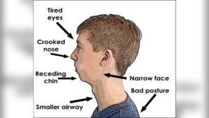 How Breathing Habits Affect Face Shape
