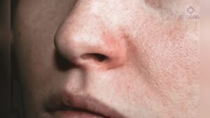 How Seasonal Allergies Affect Facial Skin