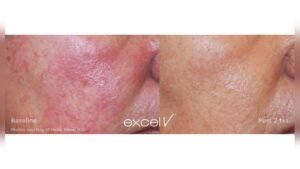 How to Calm Inflamed Red Patches on Face