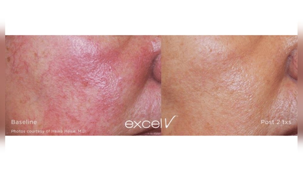 How to Calm Inflamed Red Patches on Face