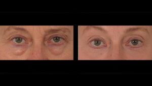 How to Fix Translucent under Eye Skin