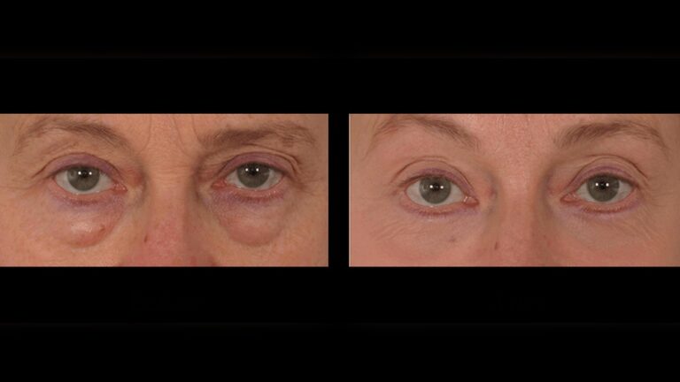 How to Fix Translucent under Eye Skin