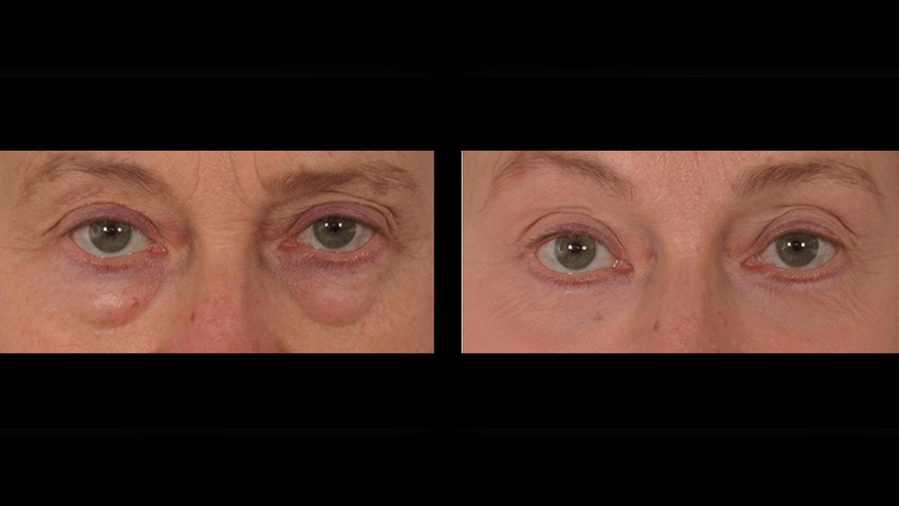 How to Fix Translucent under Eye Skin