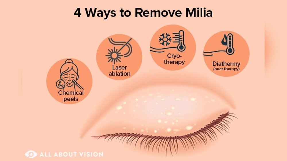 How to Treat Small Milia around Eyes
