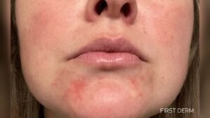 Patchy Dry Skin around Mouth Area