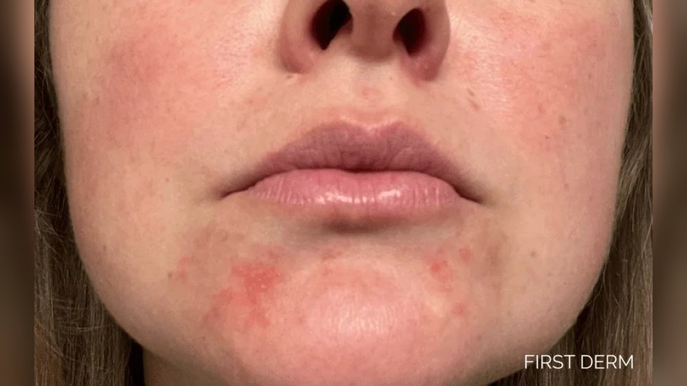 Patchy Dry Skin around Mouth Area