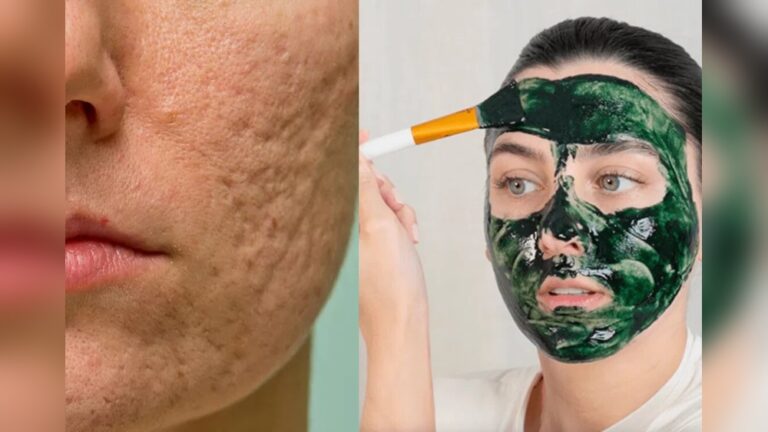 Pimple Scars That Won’T Fade Solutions