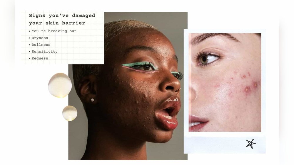 Sensitive Skin Barrier Damaged Signs