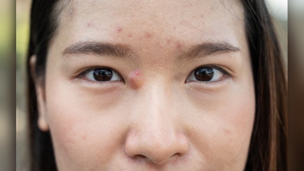 Soft Bumps on Face After Facial Treatment