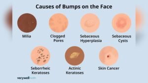 Tiny Pimples on Jawline Causes