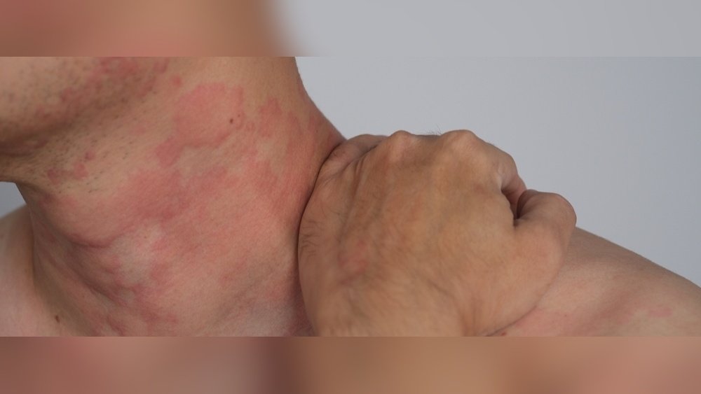 Trigger Rash on Face When Sweating
