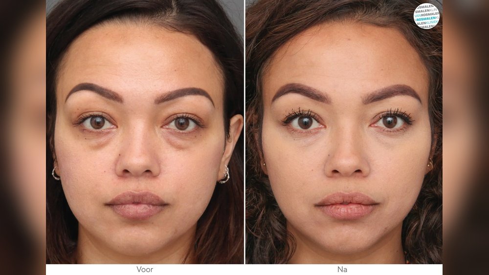 What Causes Face to Look Tired All the Time