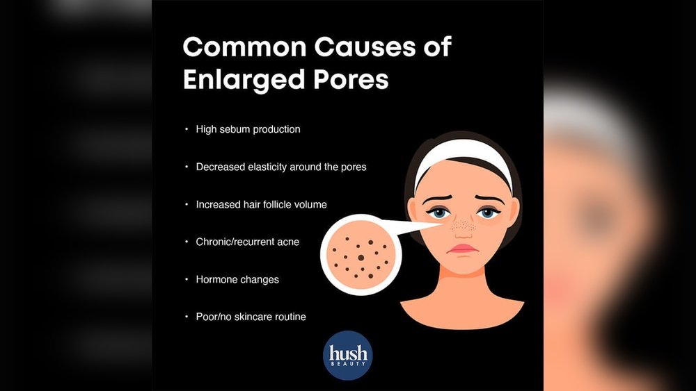 What Causes Open Pores on Nose