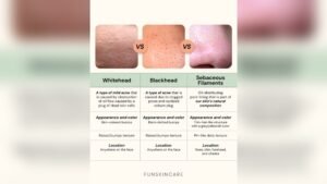 What is Sebaceous Filament Vs Blackhead