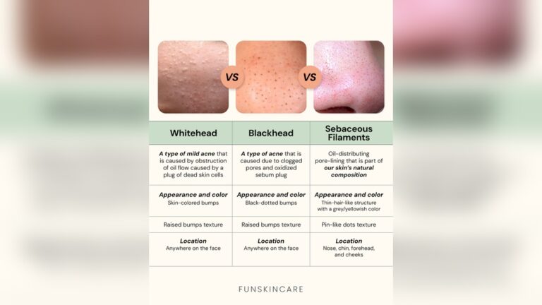 What is Sebaceous Filament Vs Blackhead
