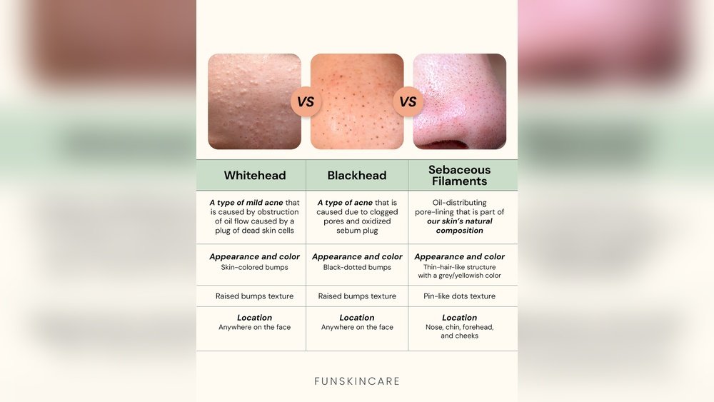 What is Sebaceous Filament Vs Blackhead